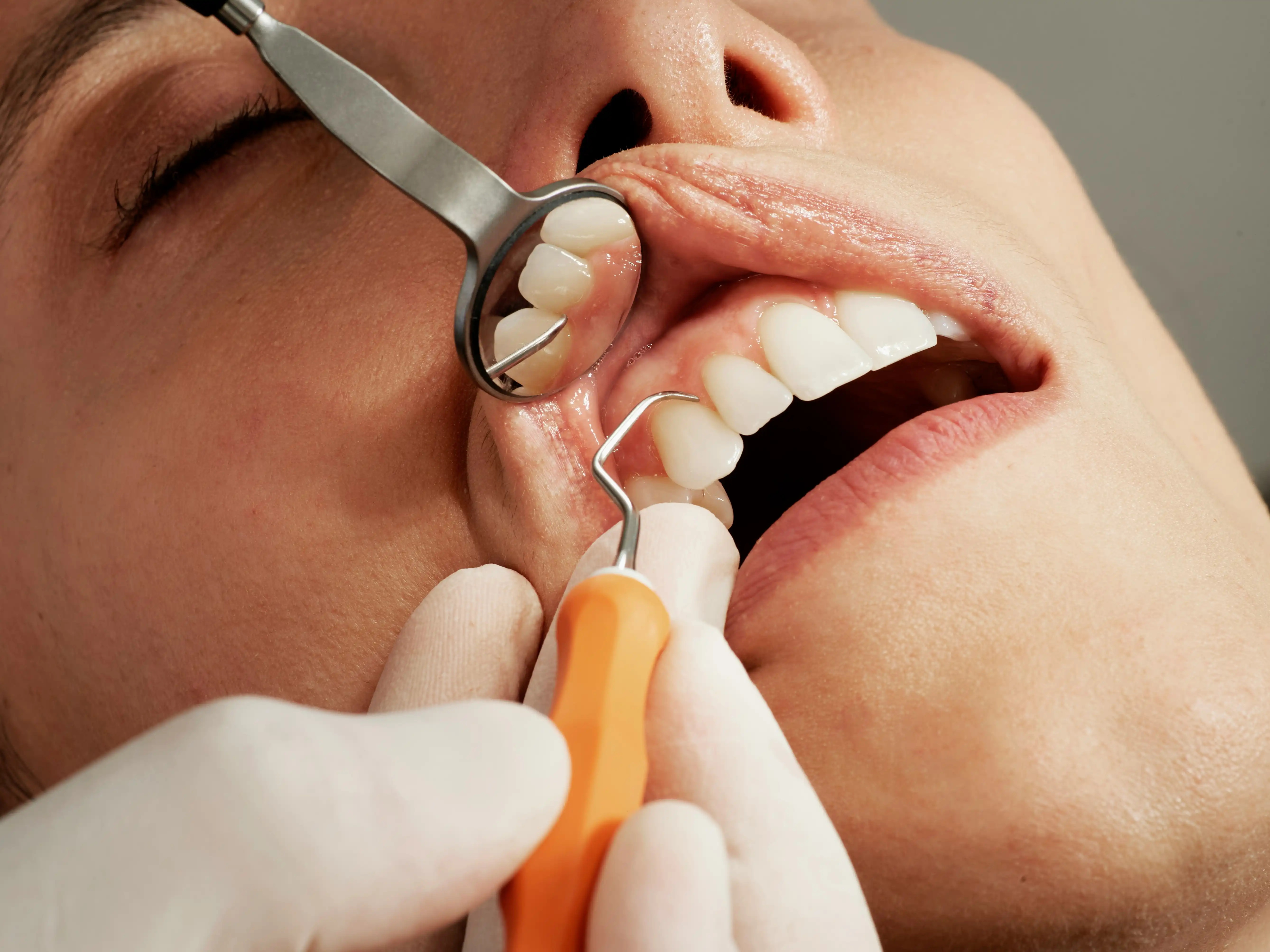 Nettoyage des dents