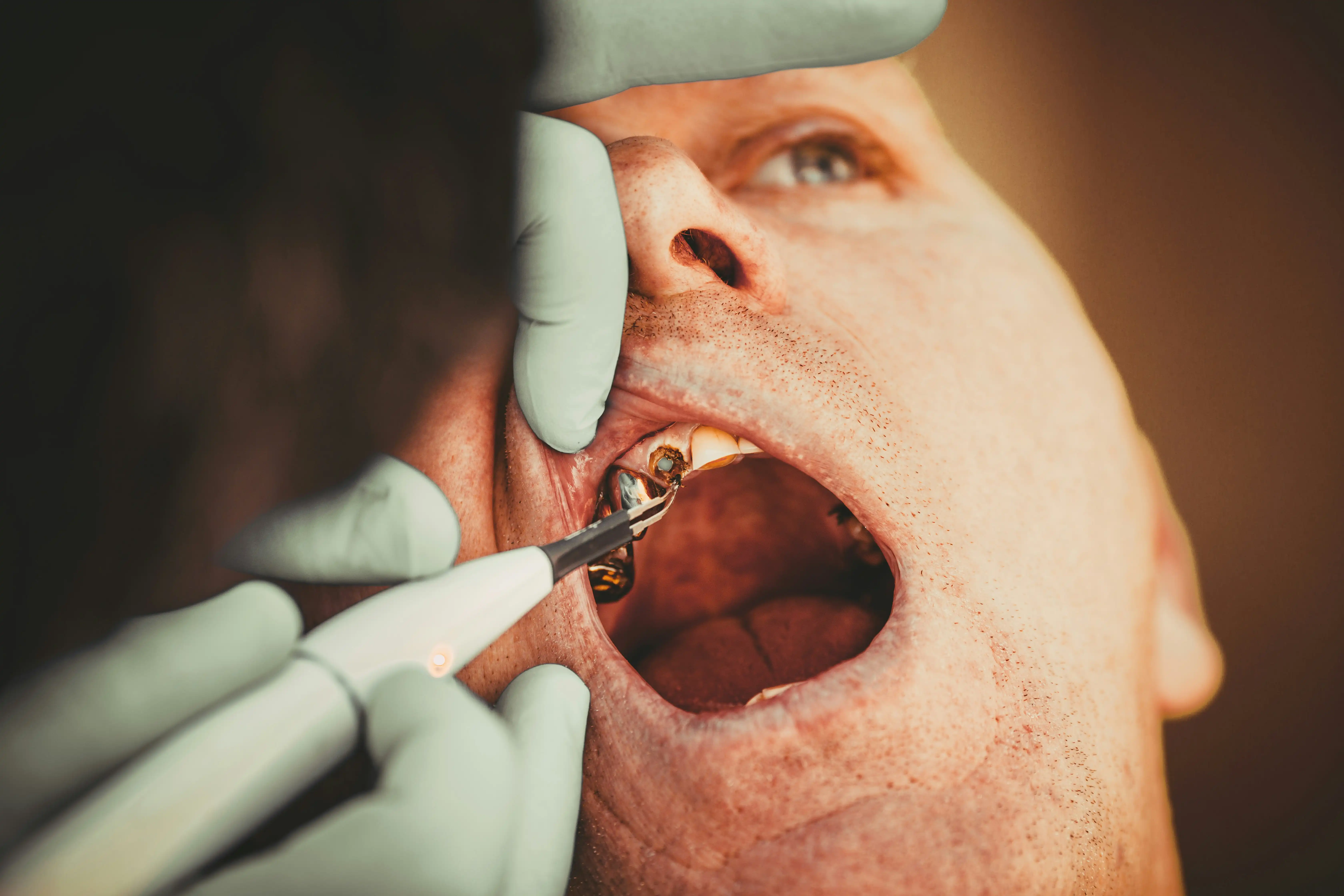 Blanchiment des dents
